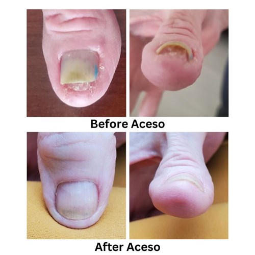 Aceso Before after